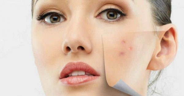 Cómo eliminar las manchas de la cara — Pudahuel