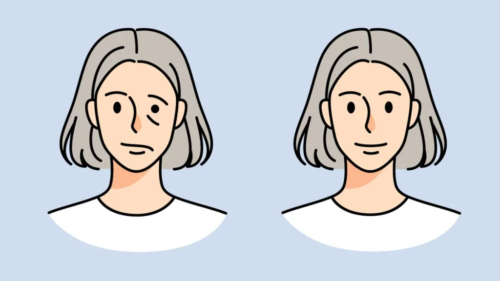 Parálisis Facial