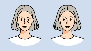Parálisis Facial