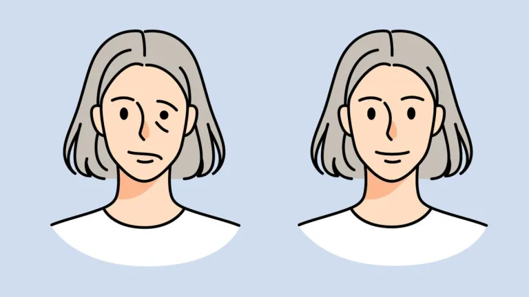 Parálisis Facial