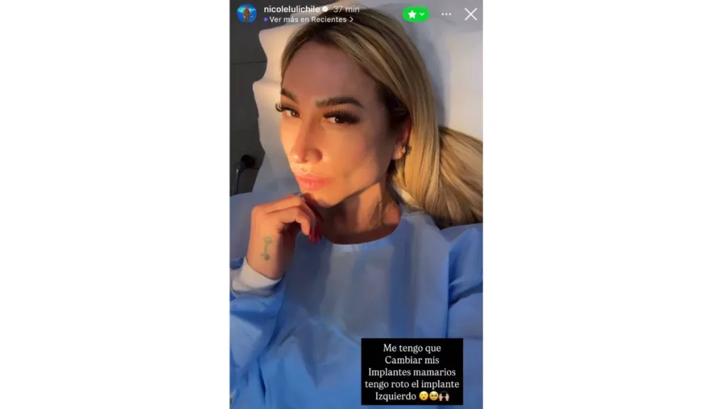 La bailarina chilena, ex reina del festival de Viña, Nicole Moreno, anunció que deberá cambiarse las prótesis mamarias.