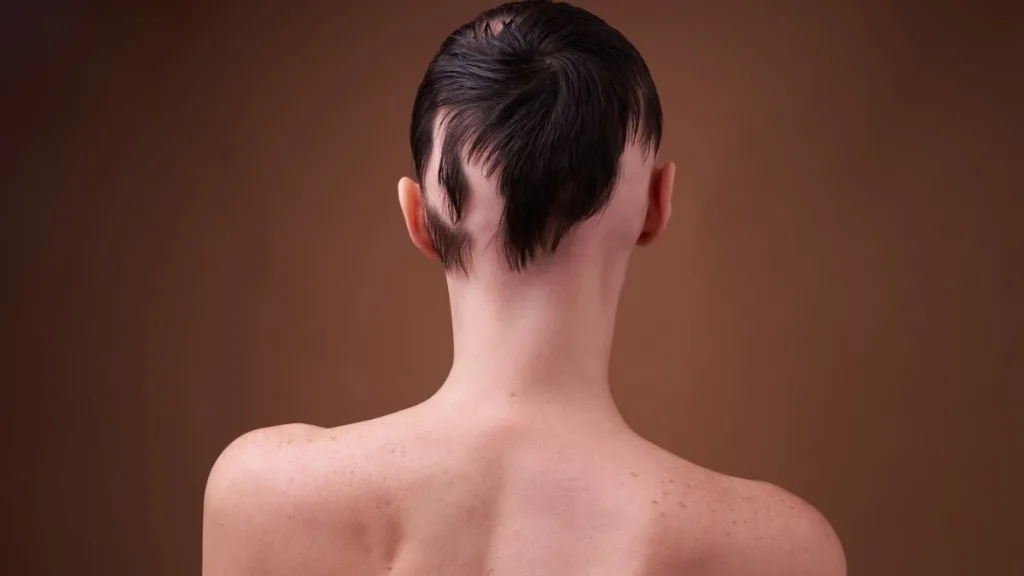 Alopecia