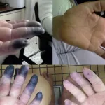 Necrosis o gangrena