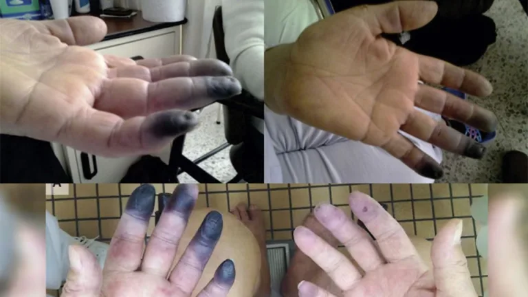Necrosis o gangrena