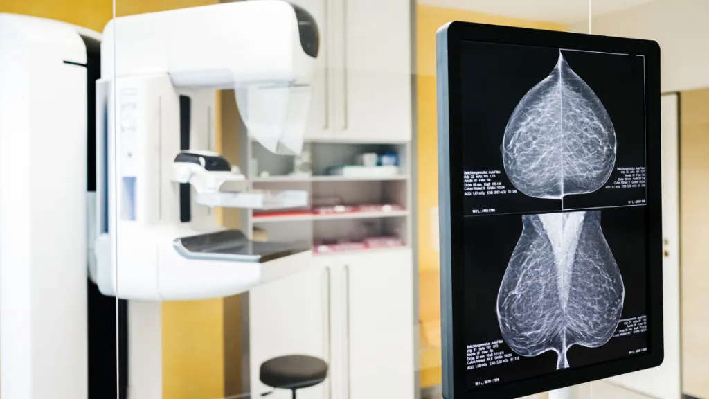 cáncer de mama y mamografía