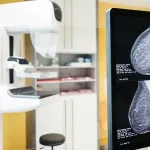 cáncer de mama y mamografía