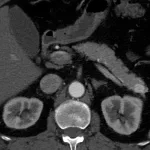 Cáncer de páncreas