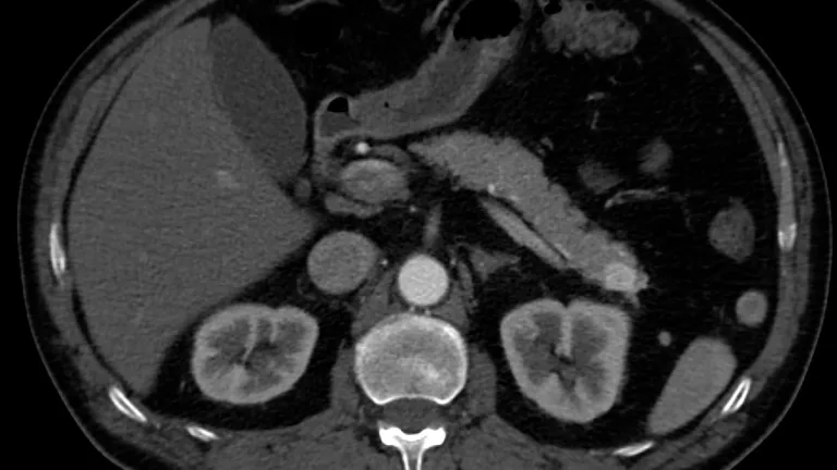 Cáncer de páncreas