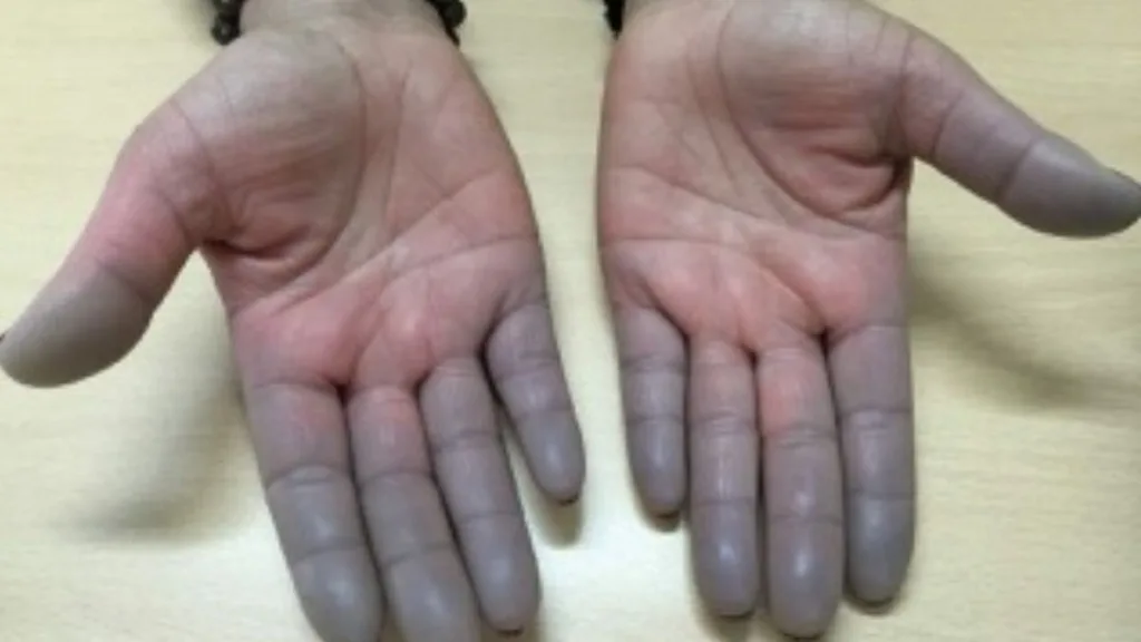 Dedos Morados Enfermedad De Raynaud