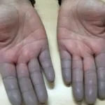 Dedos Morados Enfermedad De Raynaud