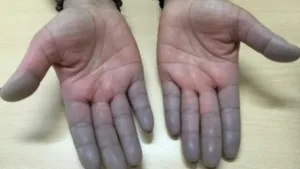 Dedos Morados Enfermedad De Raynaud